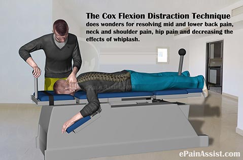 cox-zmniejszanie -przepuklin -kregoslupa -szyjnego - -flexion-distraction-technique